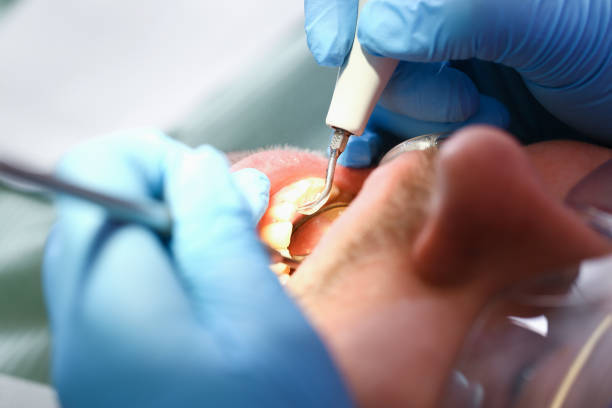 Best Emergency Root Canal Treatment in Mills River, NC